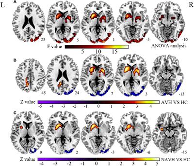Altered Coupling of Cerebral Blood Flow and Functional Connectivity Strength in First-Episode Schizophrenia Patients With Auditory Verbal Hallucinations